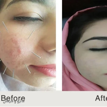 دکتر فرهاد صبری  طب سوزنی