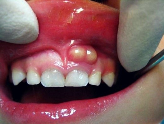 تفاوت بین عفونت دندان و آبسه چیست؟