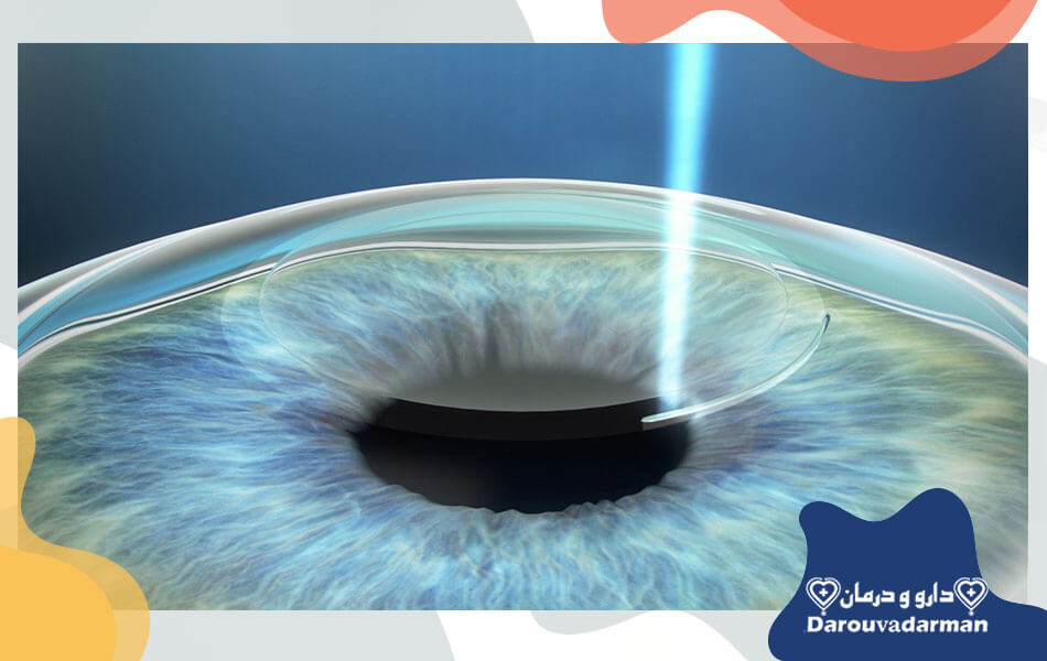 عمل فمتو لیزیک چشم چیست؟